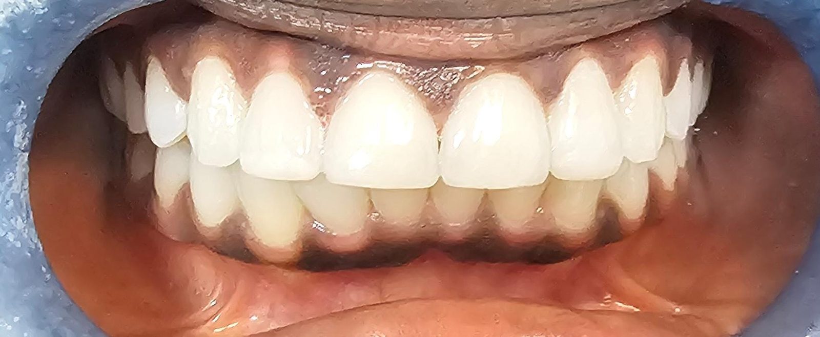After composite bonding