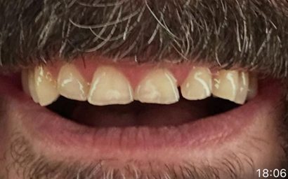 Before porcelain smile makeover