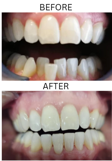 Smile transformation — Chloe Phillips, before and after treatment with Dr. Mani