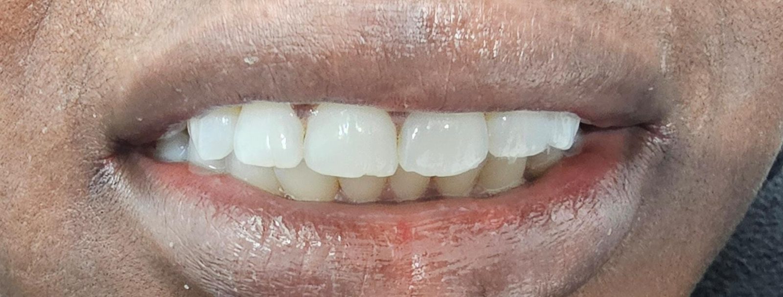 Before composite bonding