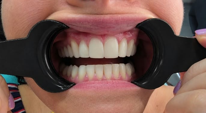 Patient smile after treatment at Welling Dental Studio — case 3