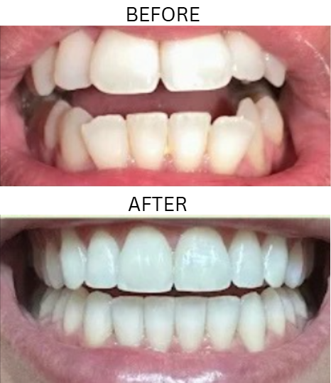 Smile transformation — Melissa Jones, before and after treatment with Dr. Mani