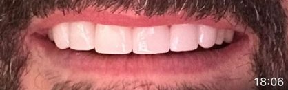After porcelain smile makeover