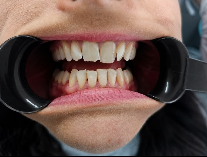 Patient smile before treatment at Welling Dental Studio — case 3