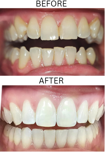 Smile transformation — Diella Salihu, before and after treatment with Dr. Mani